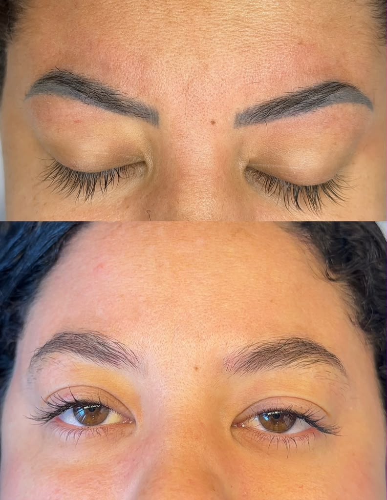 Laser de Sobrancelhas