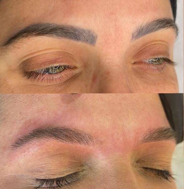 Remoção a laser de sobrancelhas