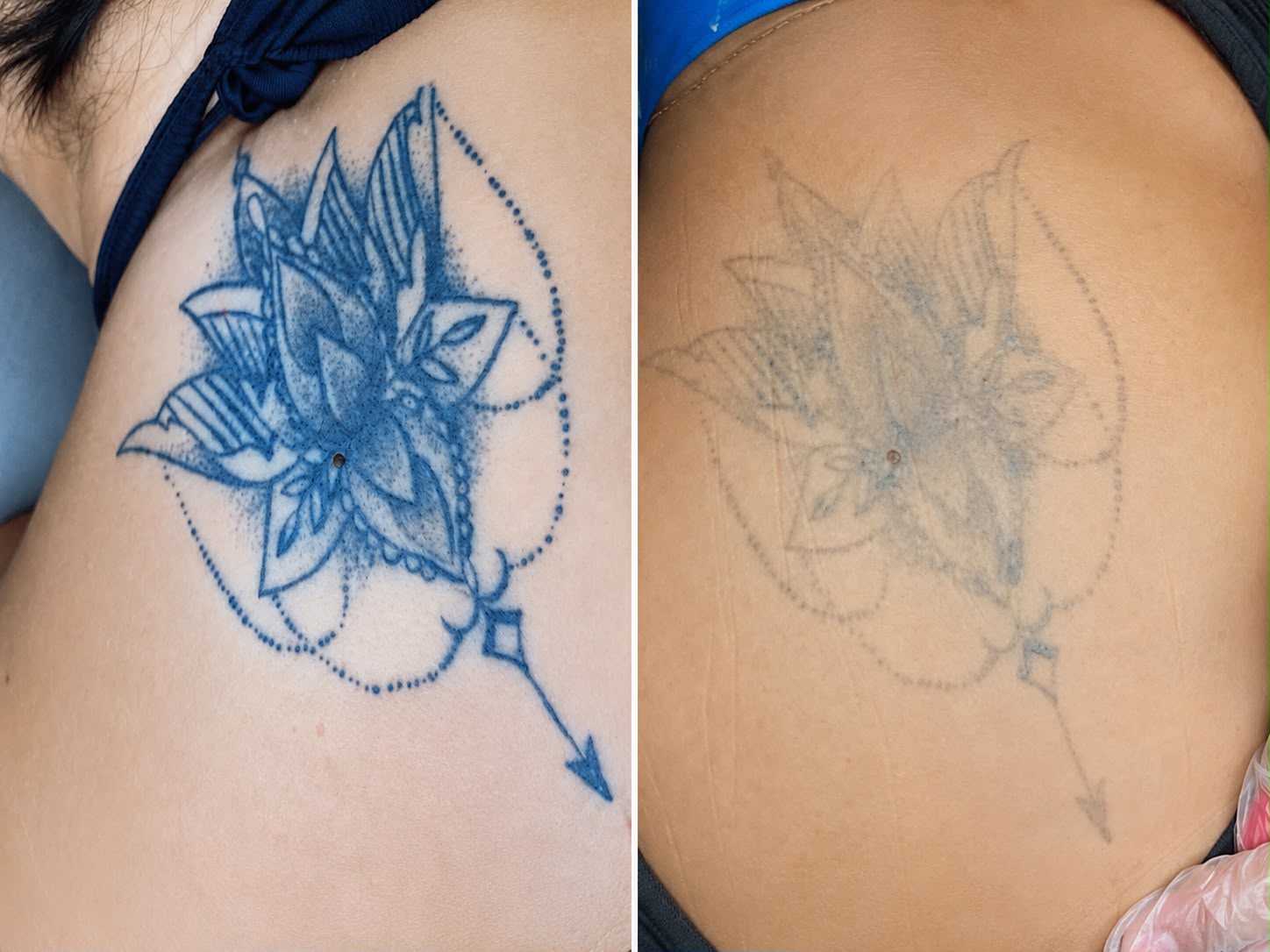 Remoção de tatuagem a laser
